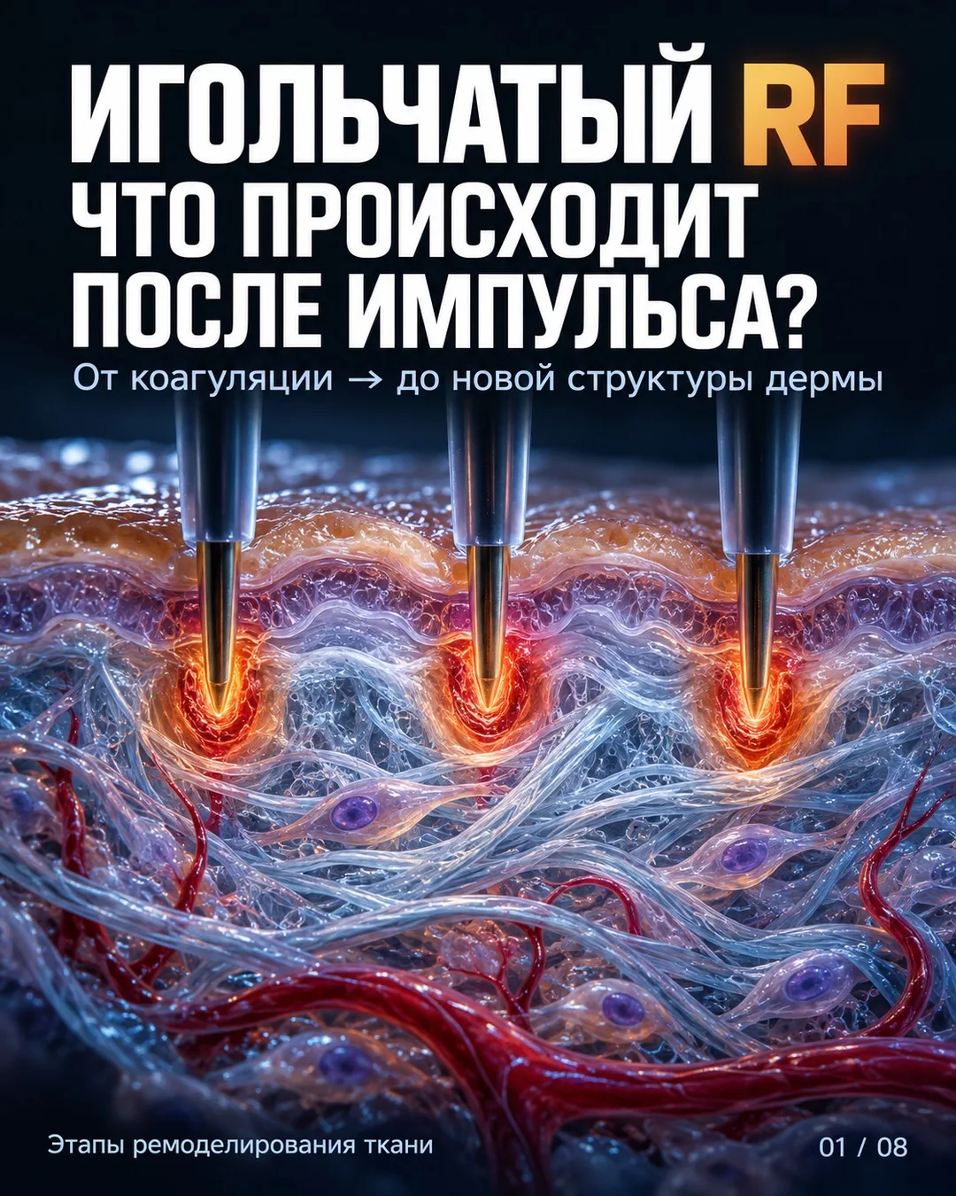 ИГОЛЬЧАТЫЙ RF: ИМПУЛЬС ДЛИТСЯ МИЛЛИСЕКУНДЫ. А ЧТО ПОТОМ? 🔬