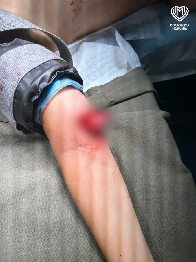 9-летний мальчик чуть не потерял руку после падения с питбайка в Москве