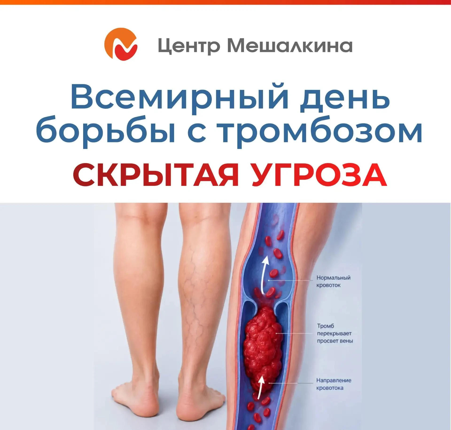 Накануне Всемирного дня борьбы с тромбозом, отмечаемого 13 октября, рассказываем в карт...