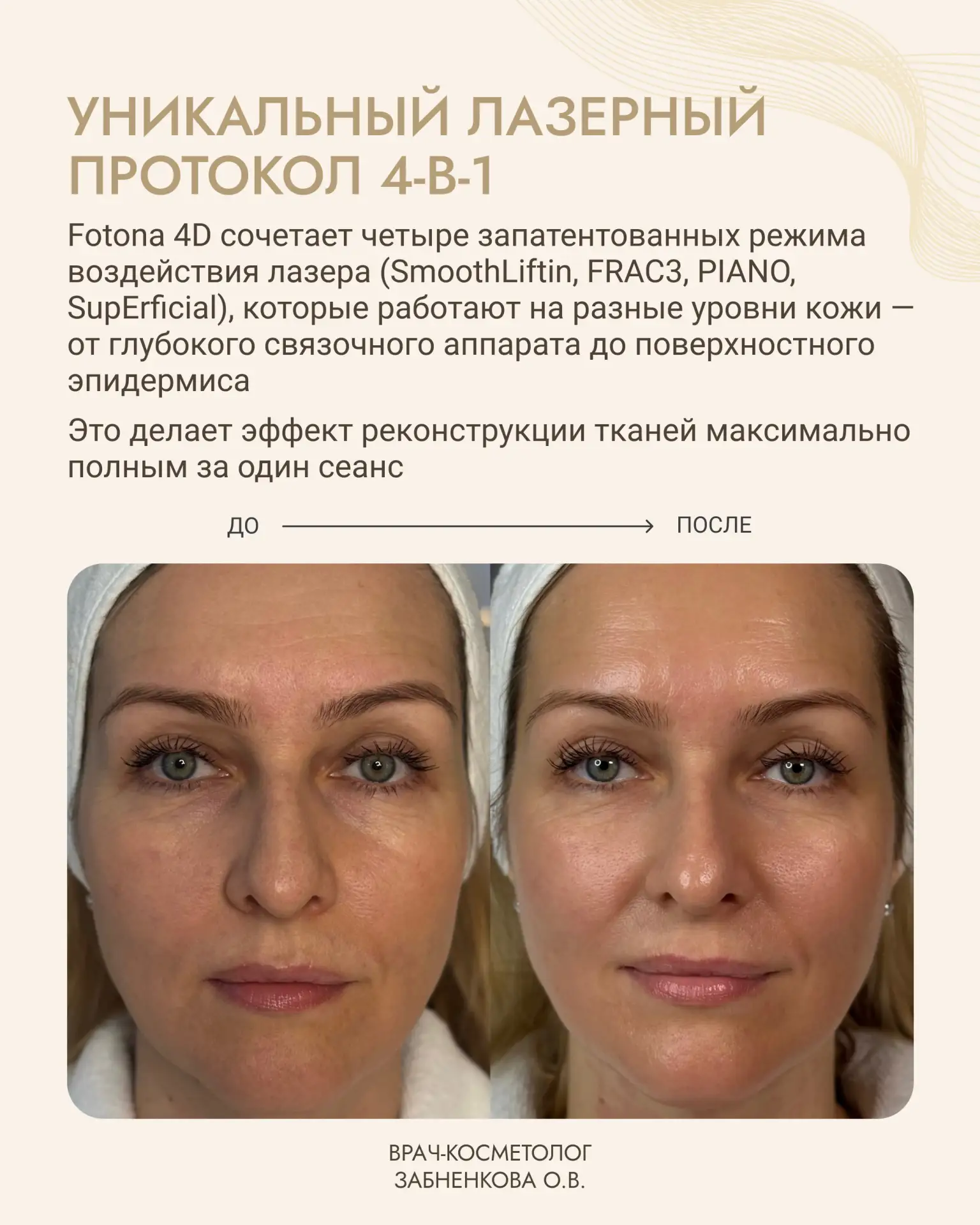 4-МЕРНОЕ ОМОЛОЖЕНИЕ FOTONA 4D: АЛЬТЕРНАТИВА ПЛАСТИЧЕСКОЙ ХИРУРГИИ
