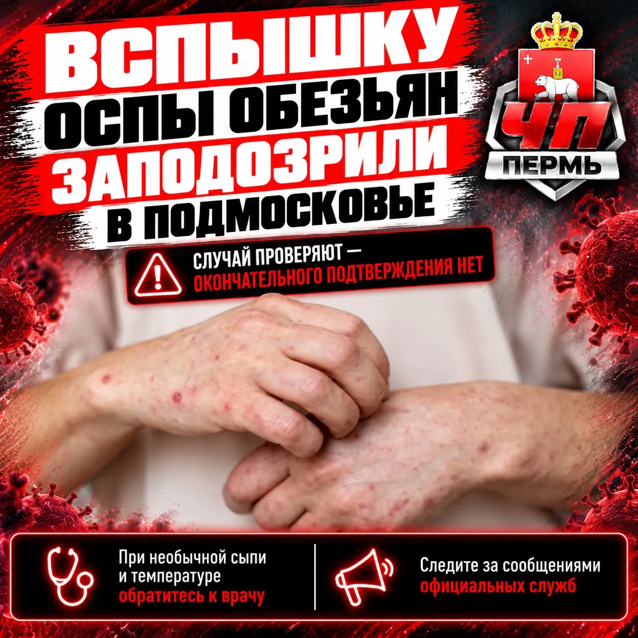 ❗️Вспышку оспы обезьян заподозрили в Подмосковье — сразу пять человек попали в больницу...