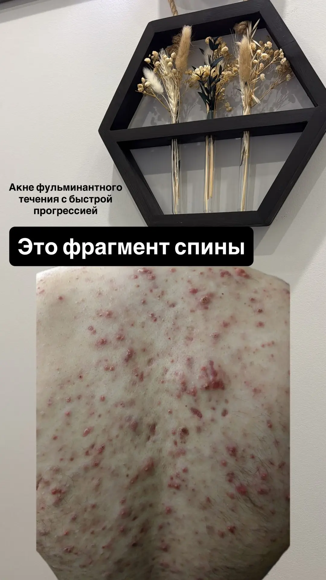 - Дайте ретиноиды!
