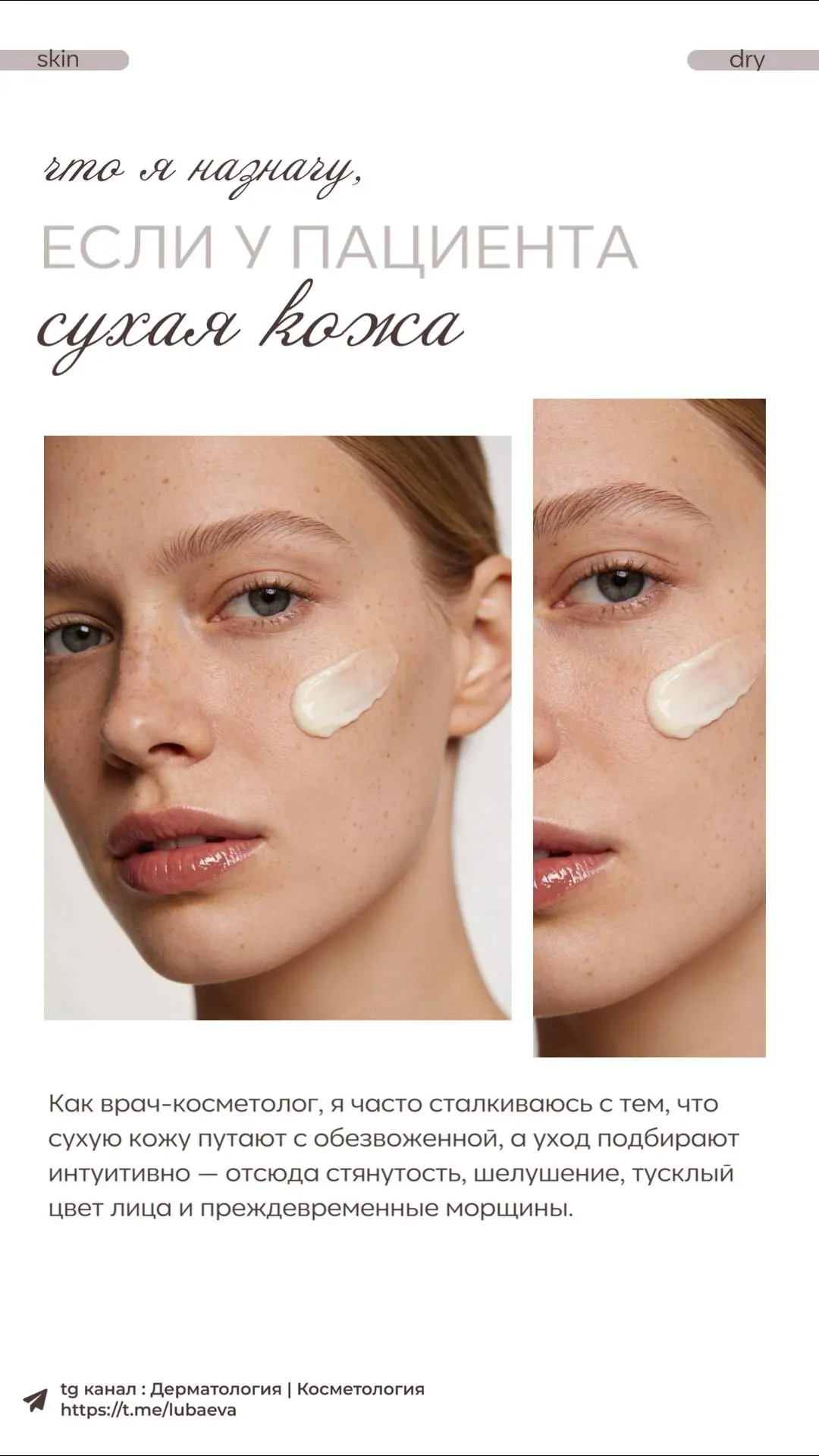 Сухая кожа — это тип кожи.