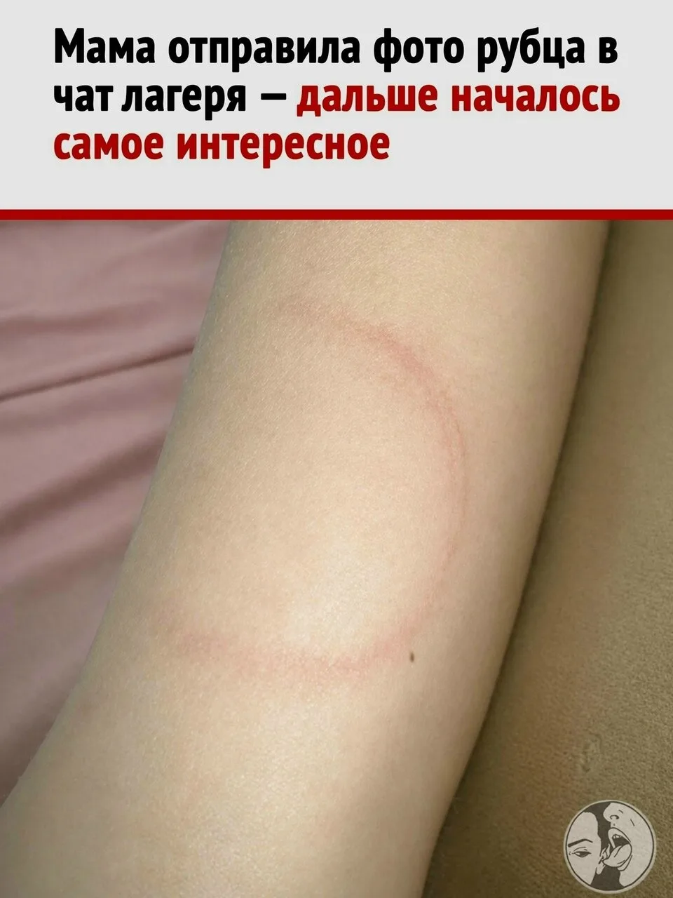 Скакалка зацепила ногу в лагере, но родителей удивило совсем не это