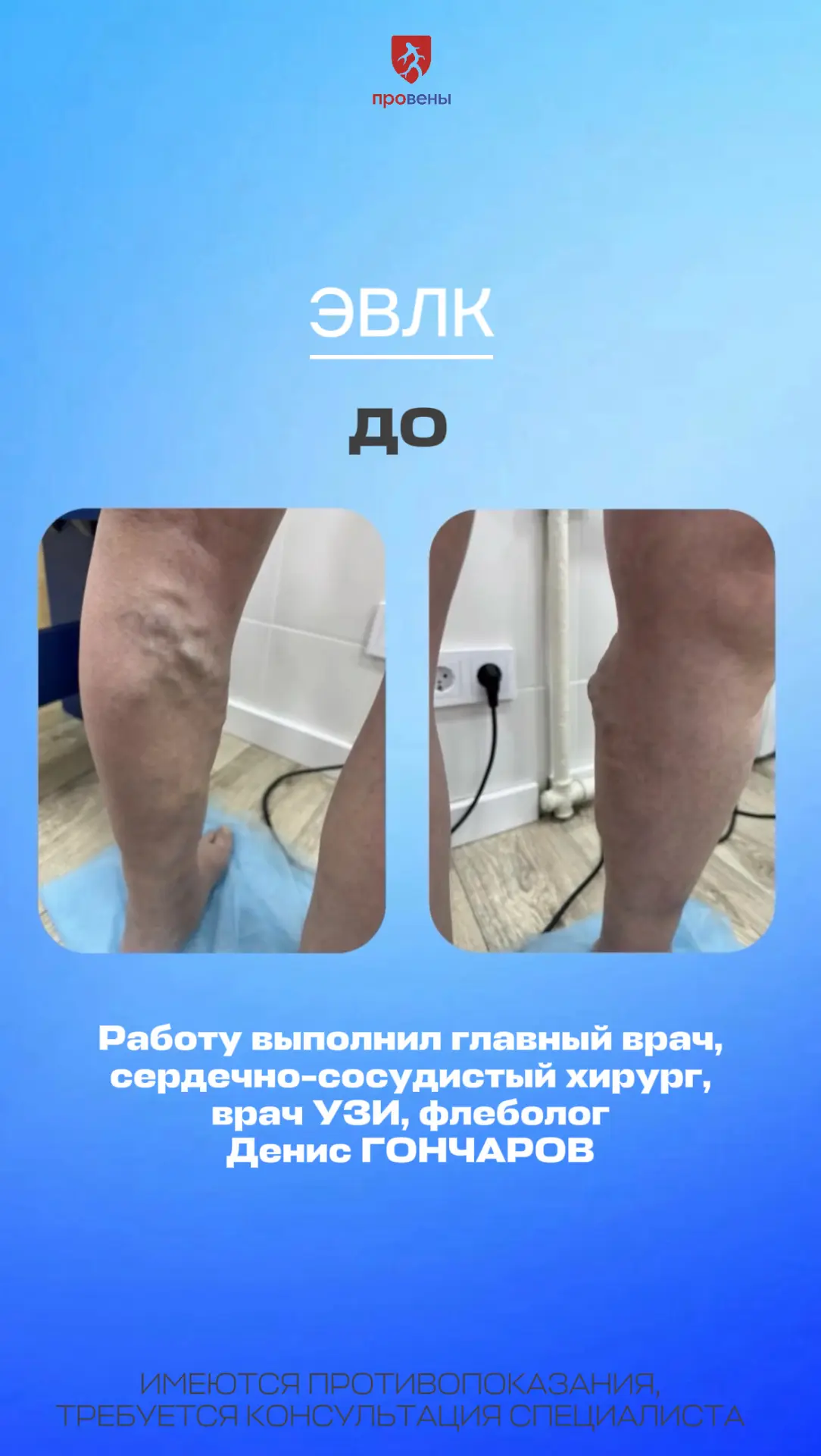 Лазерное лечение варикоза. Результат до операции и спустя полтора месяца.