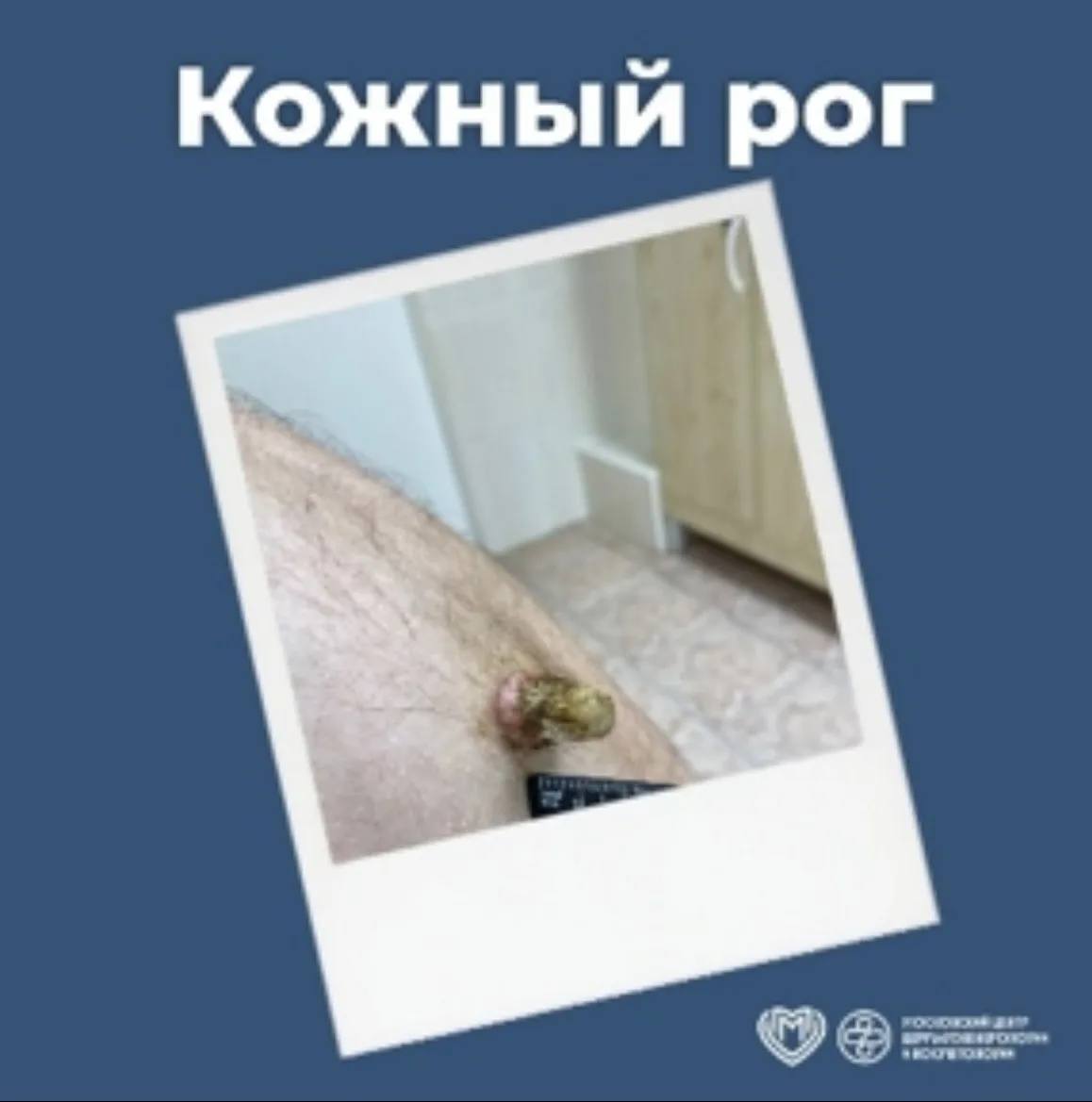 ☝️Одним из необычных новообразований кожи является так называемый кожный рог.