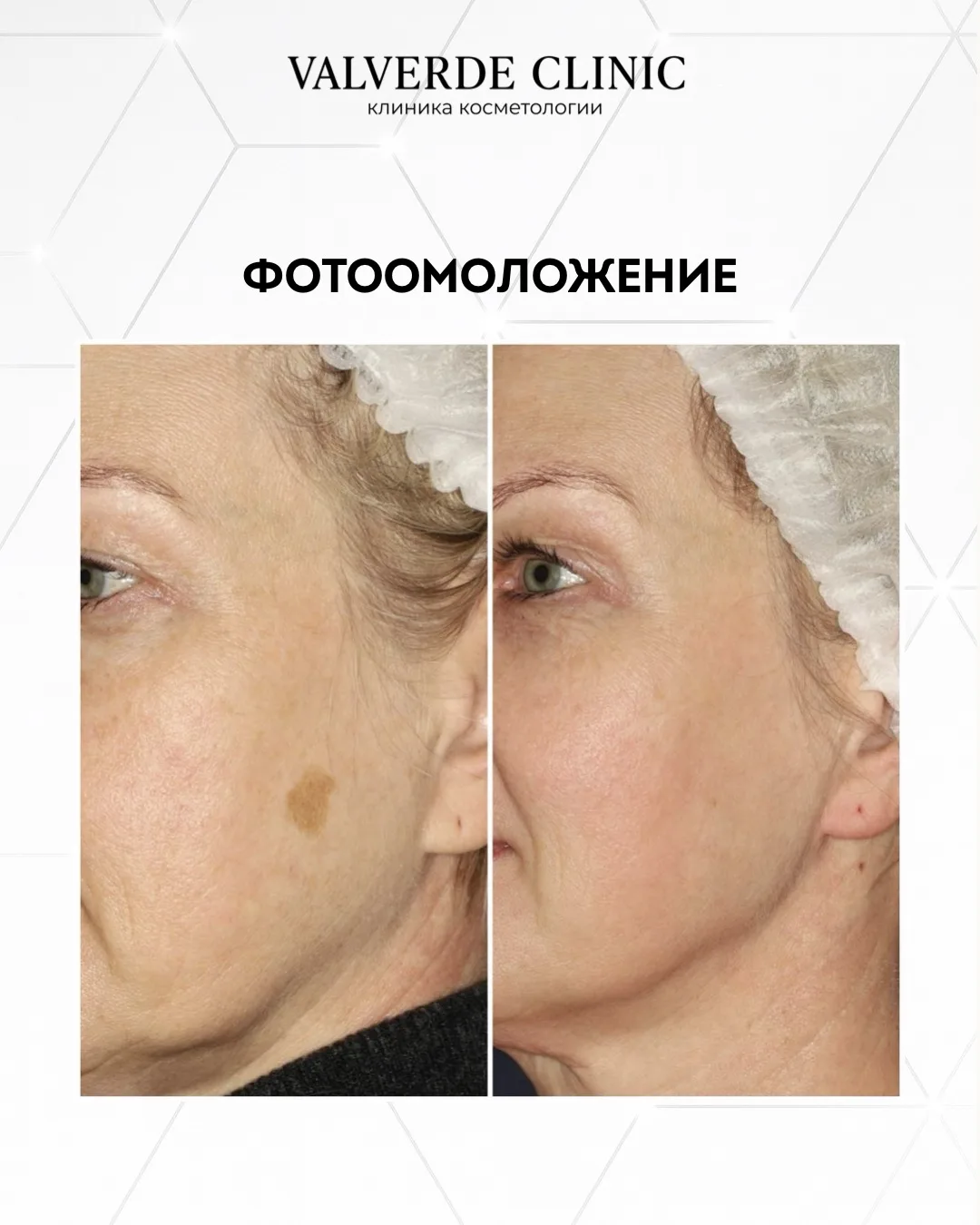 ПИГМЕНТАЦИЯ НЕ ПРОЙДЁТ САМА. А ВОТ УБРАТЬ ЕЁ МОЖНО! 🍂