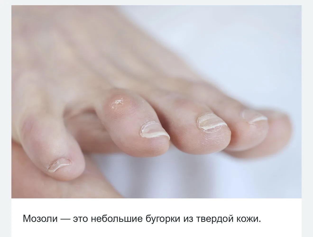 👣 Сегодня поговорим о стержневой мозоли.