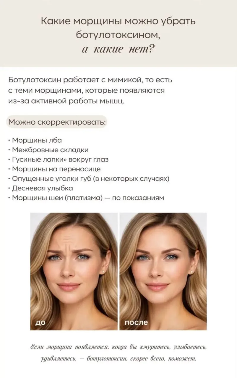 #ботулинотерапия