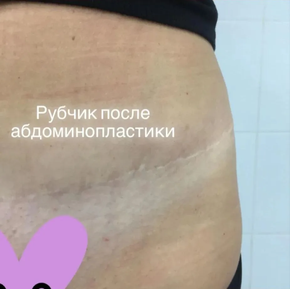 🩹Фото рубчика моей прекрасной пациентки после абдоминопластики.