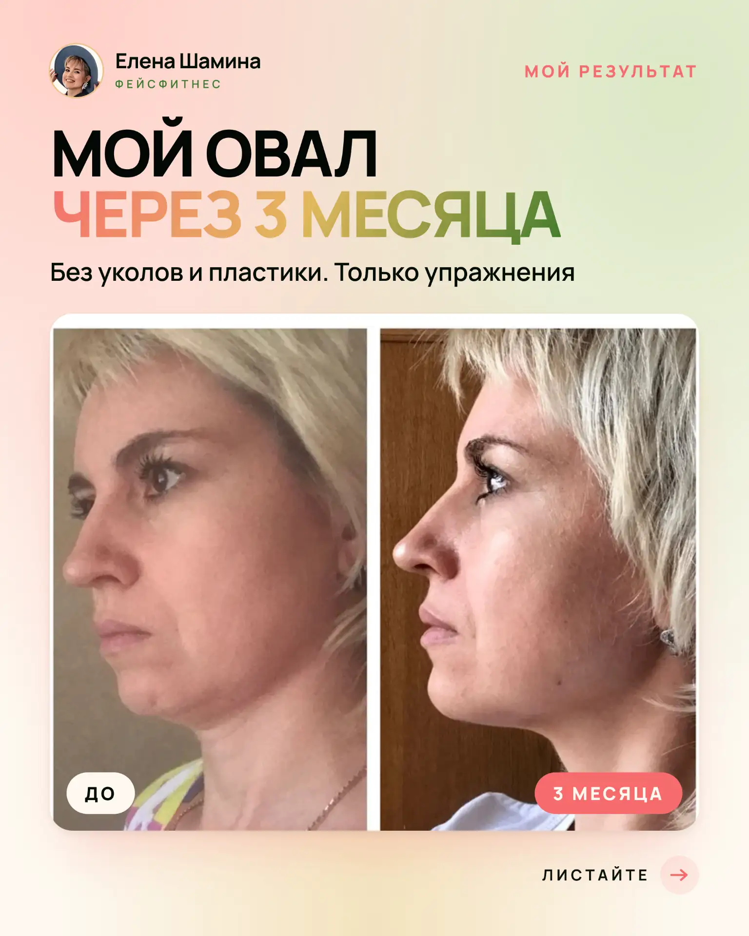 Мой результат за 3 месяца, без уколов и пластики 👇