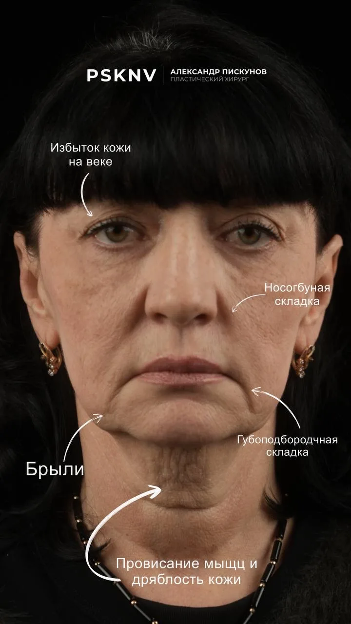 1 месяц после фейслифтинга( DEEP SMAS), платизмопластики, височного лифтинга и блефароп...