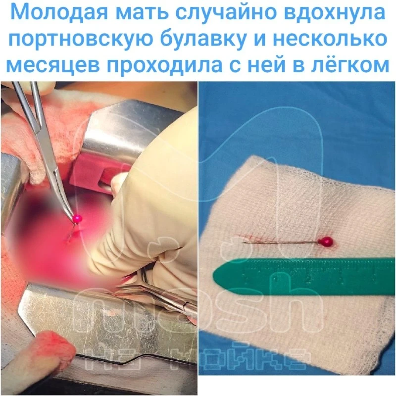 🚑 В Новочеркасске девушка вдохнула булавку