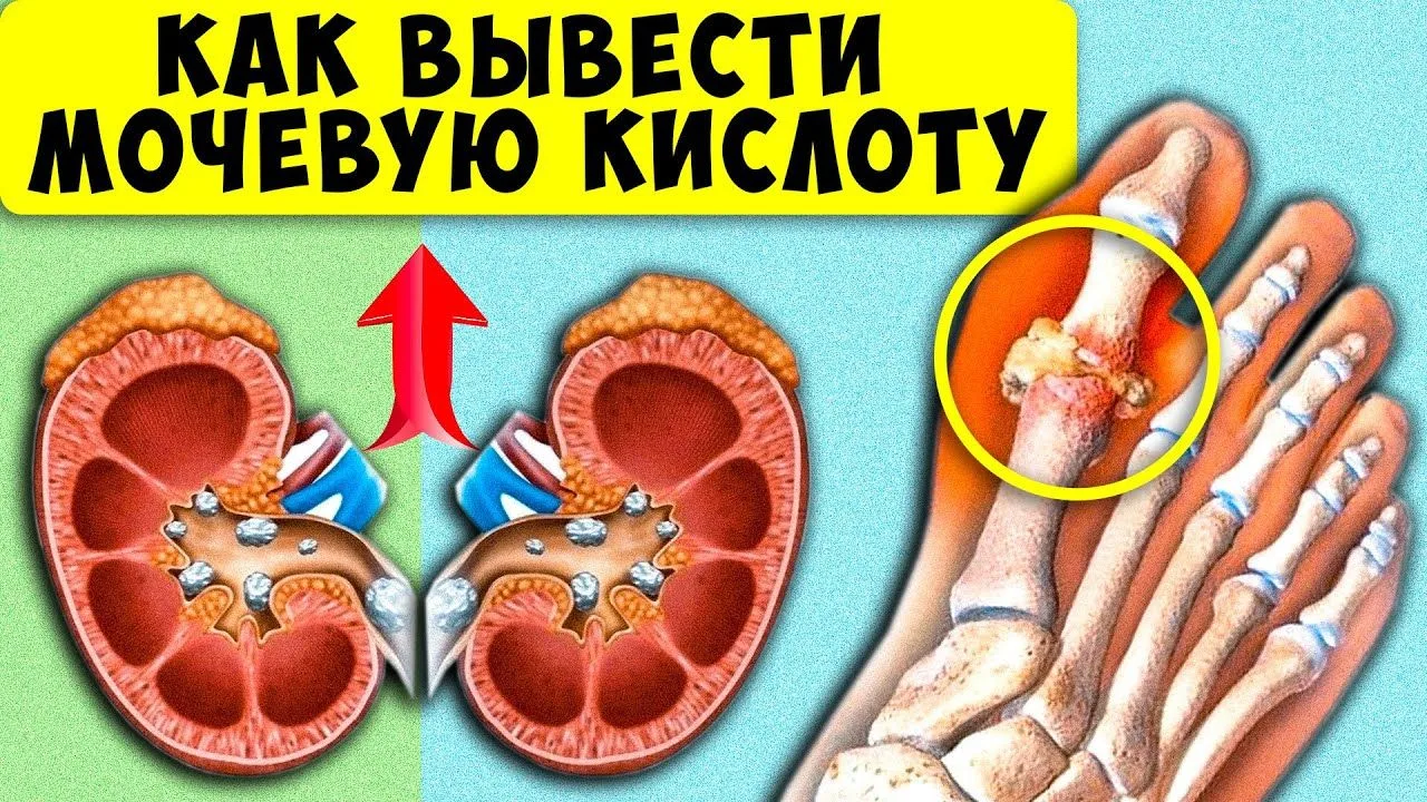 Как удалить мочевую кислоту из суставов и избежать подагры?