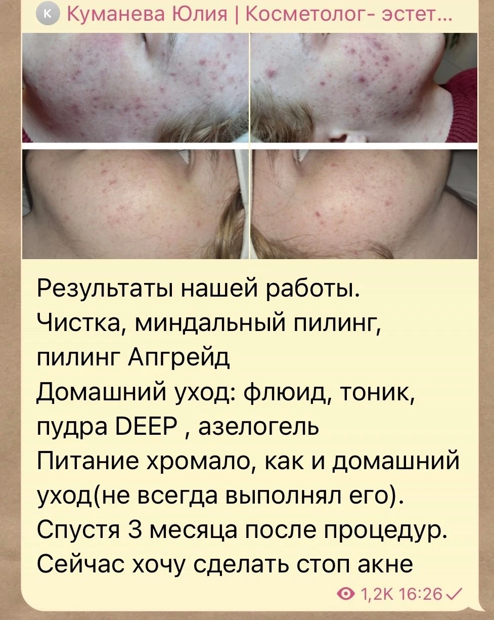 Акне 4 степени. Как уменьшить проявления без ретиноидов?