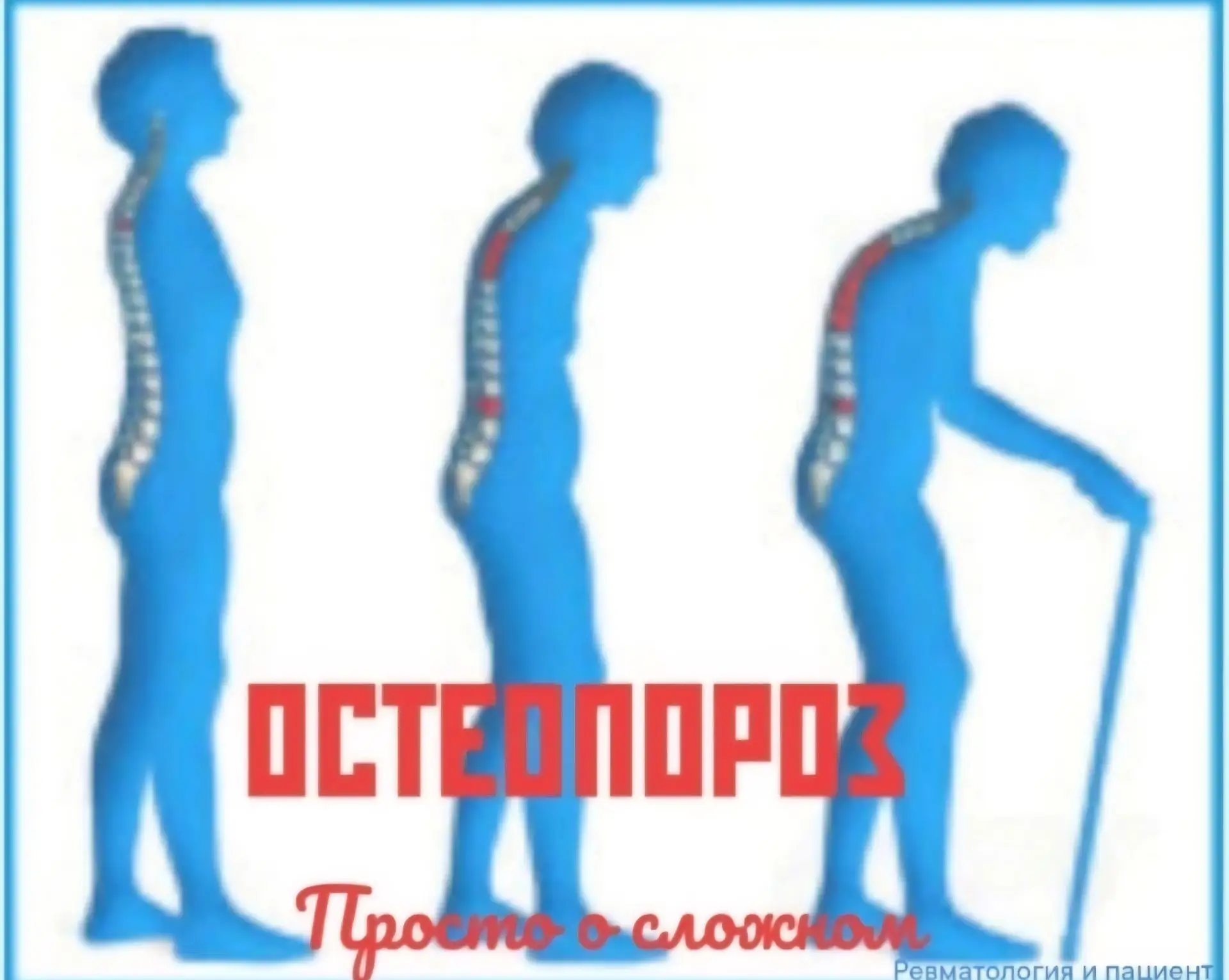 Сегодня поговорим об остеопорозе.