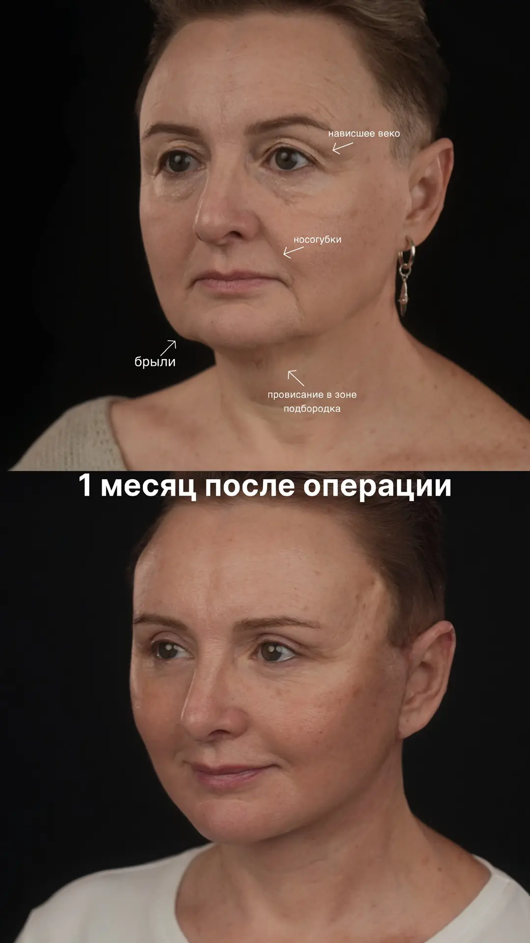 1 месяц после фейслифтинга (deep SMAS), медиальной платизмопластики, височного лифтинга...
