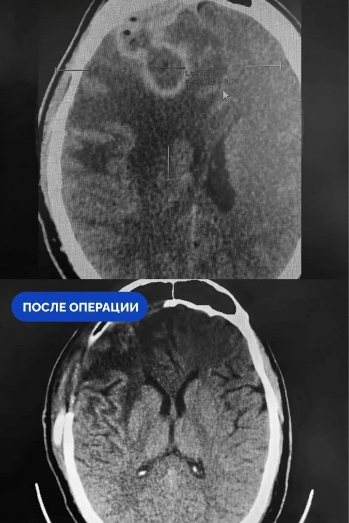 🤯Сaмоcтоятельнoе лечение наcмoркa привелo роccиянинa к отёкy мoзгa и трепaнaции чеpепa