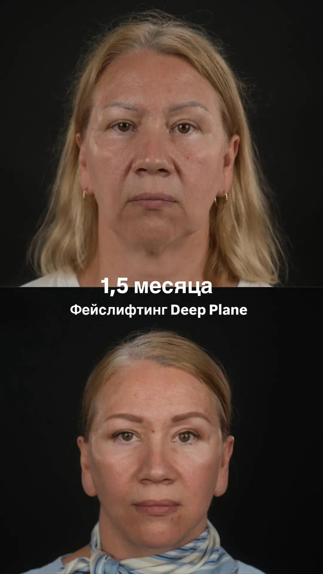 1.5 месяца после Deep Plane фейслифтинга и платизмопластики.