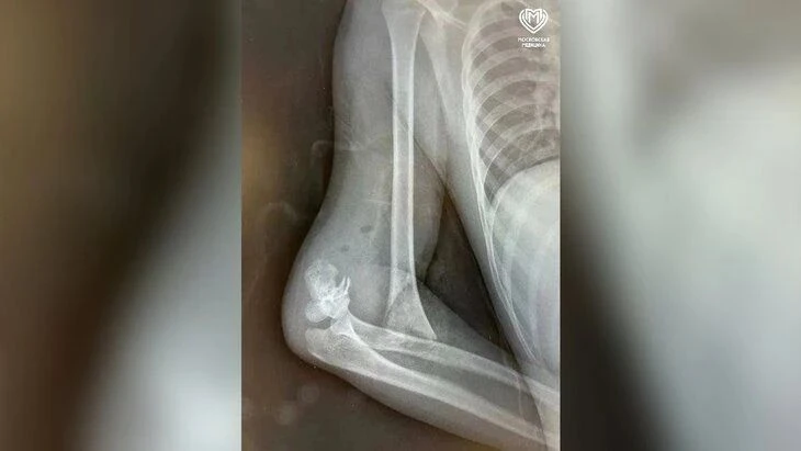 ❗В Москве спасли 9-летнего мальчика, упавшего с питбайка.