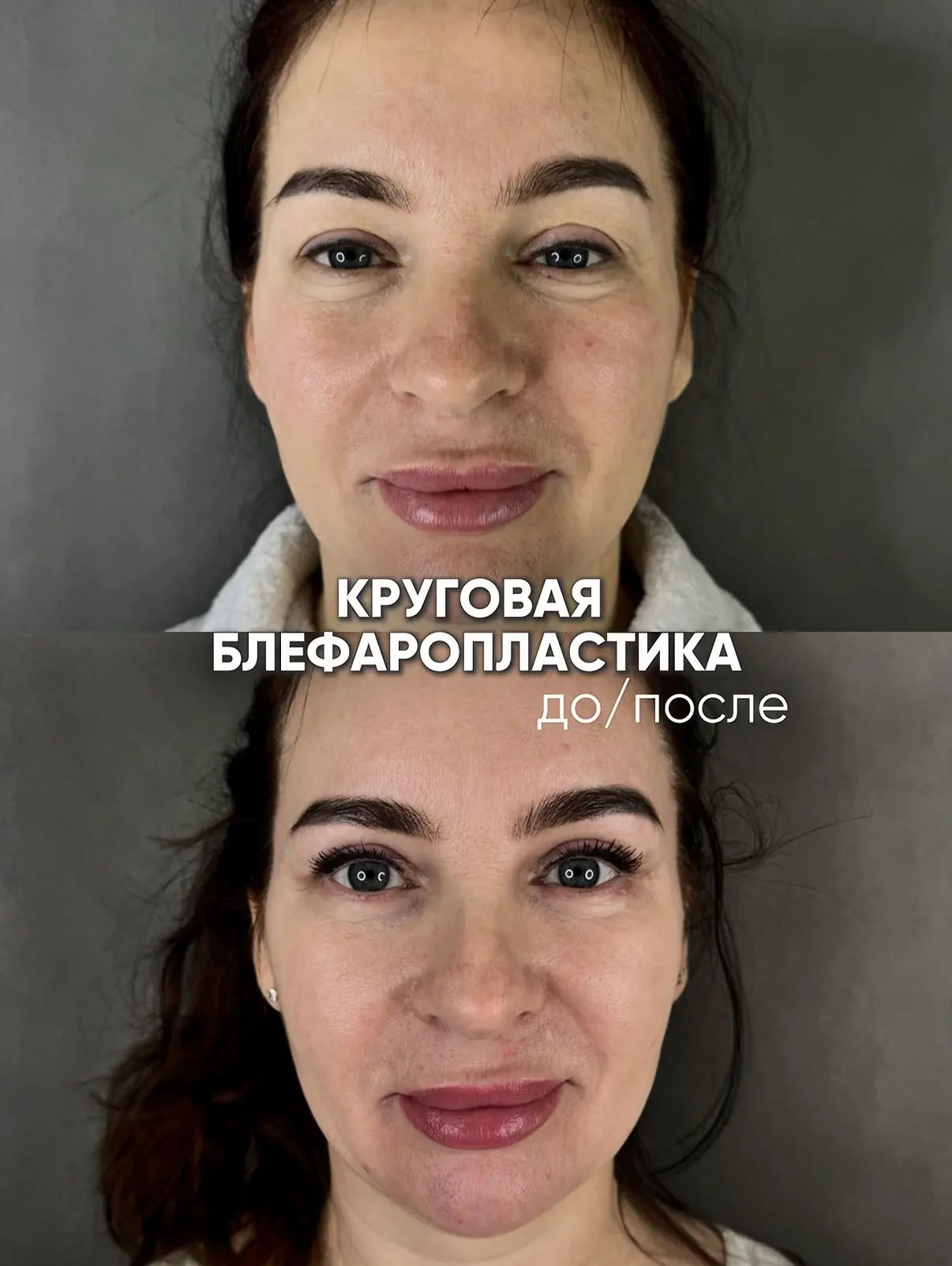 Блефаропластика как она есть👀