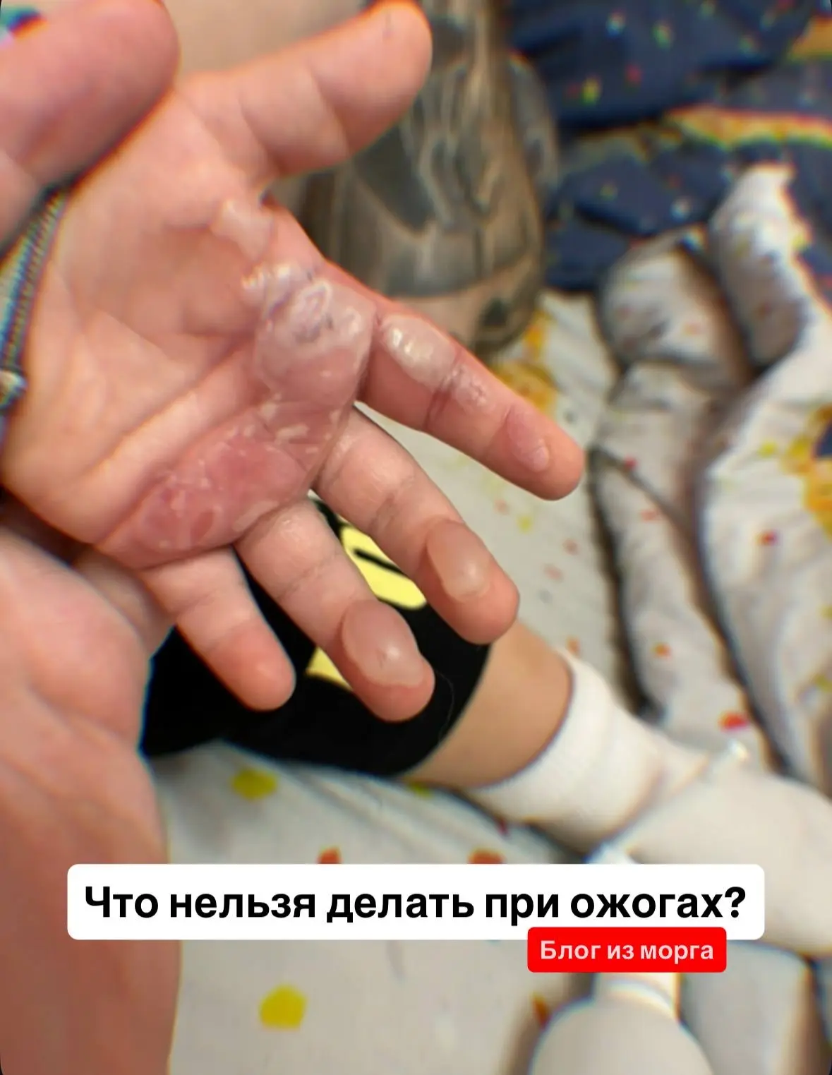 Напоминаю! Что нельзя делать при ожогах - запомните раз и навсегда!