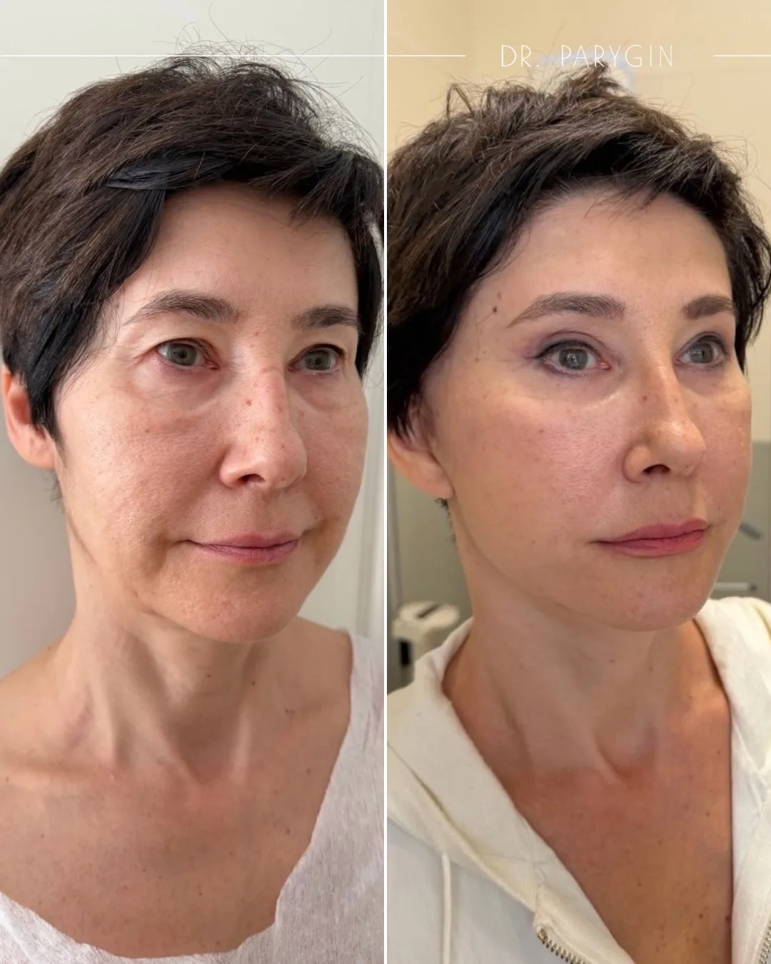 😍 Deep Plane Facelifting