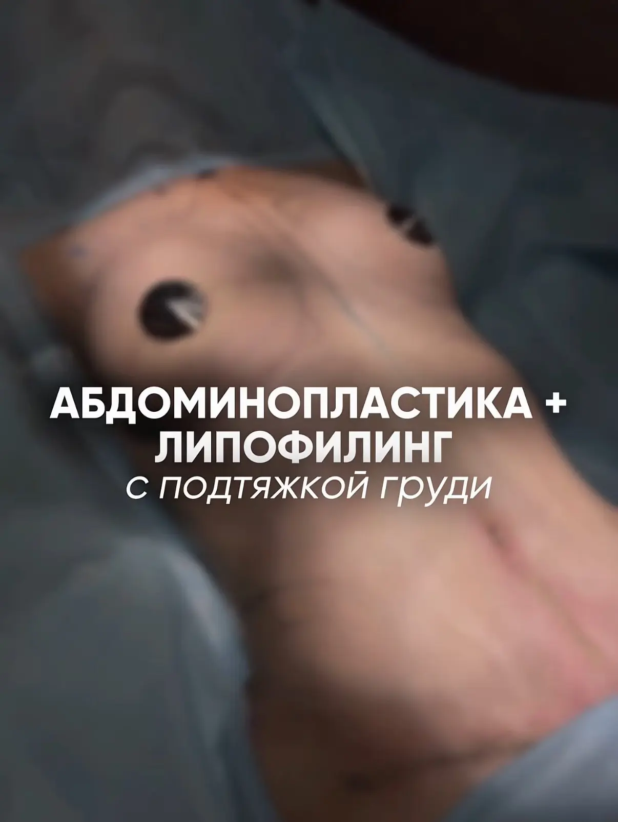 Подтяжка груди и живота может отличаться в зависимости от исходника и запроса.
