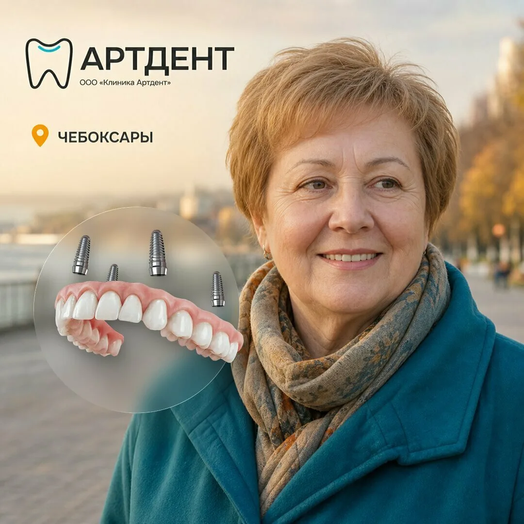 Протез на 4 имплантах — 98 700 ₽. Осмотр 0₽. Чебоксары