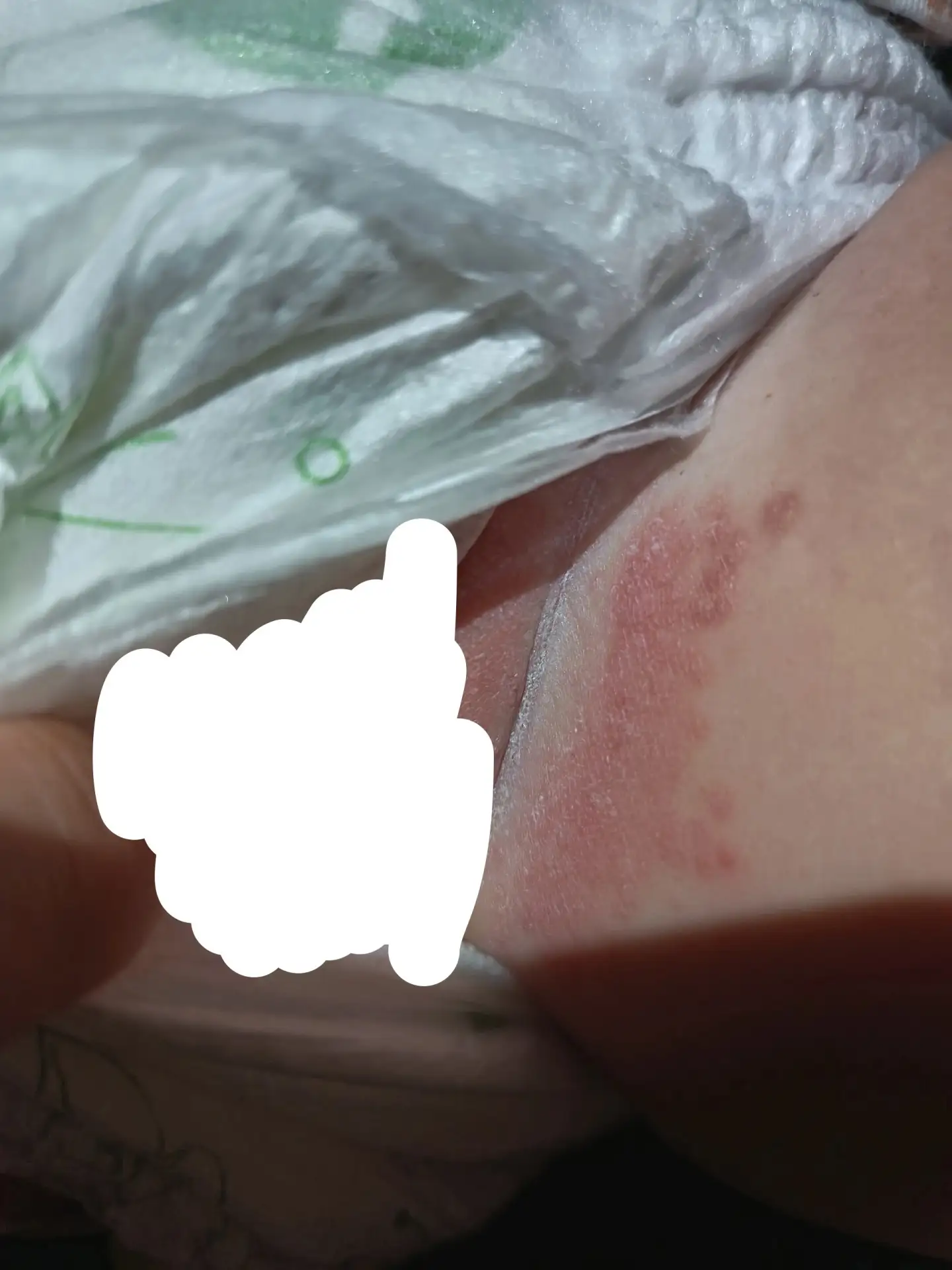 Анонимно пожалуйста) здравствуйте подскажите пожалуйста это аллергия на памперсы или на...