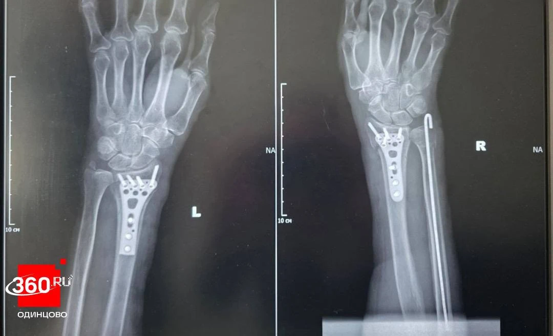👨‍⚕️ Одинцовские врачи прооперировали пациентку с переломами обеих рук