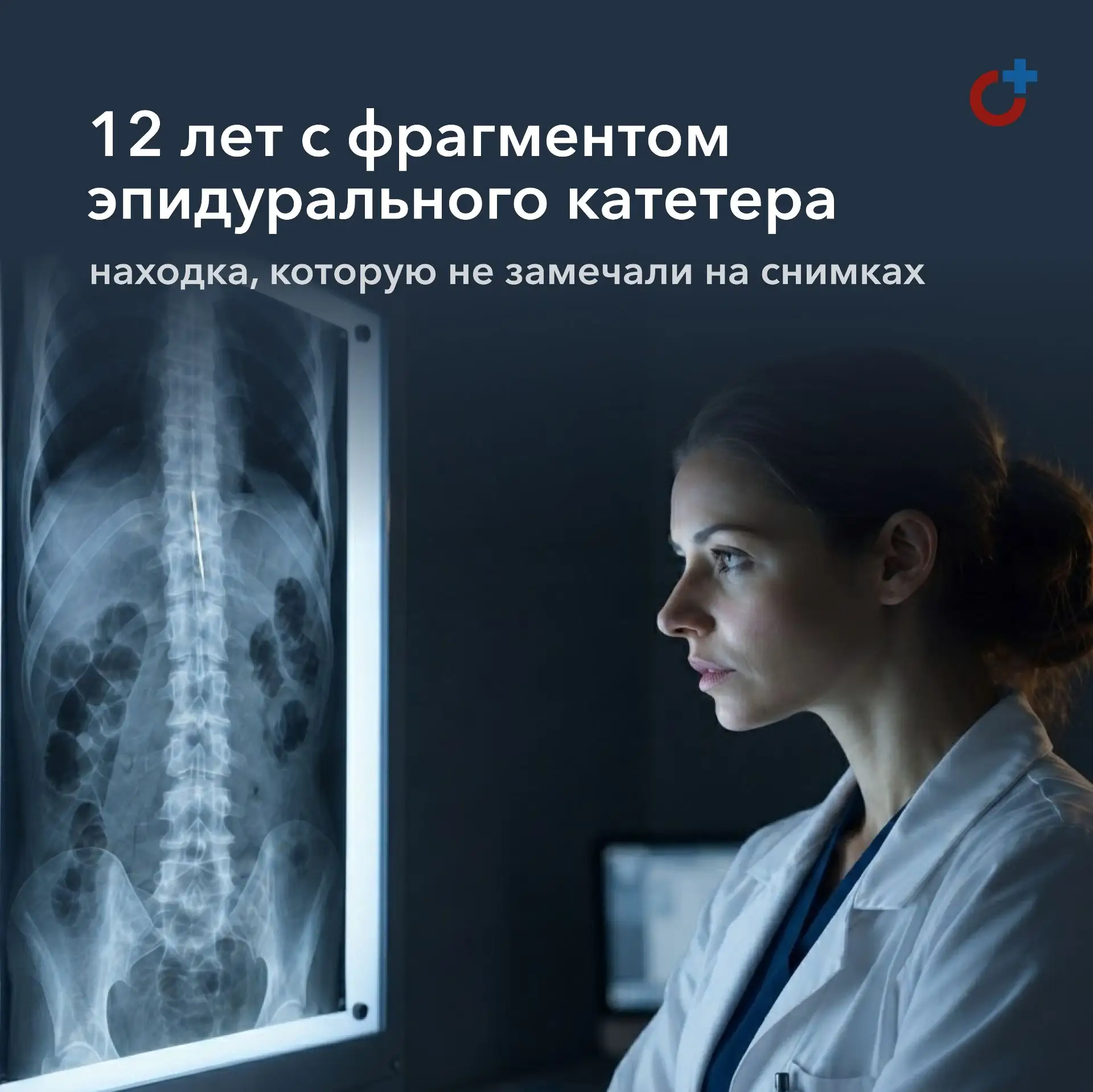Катетер, оставшийся после удаления. Клинический случай ятрогенного инородного тела
