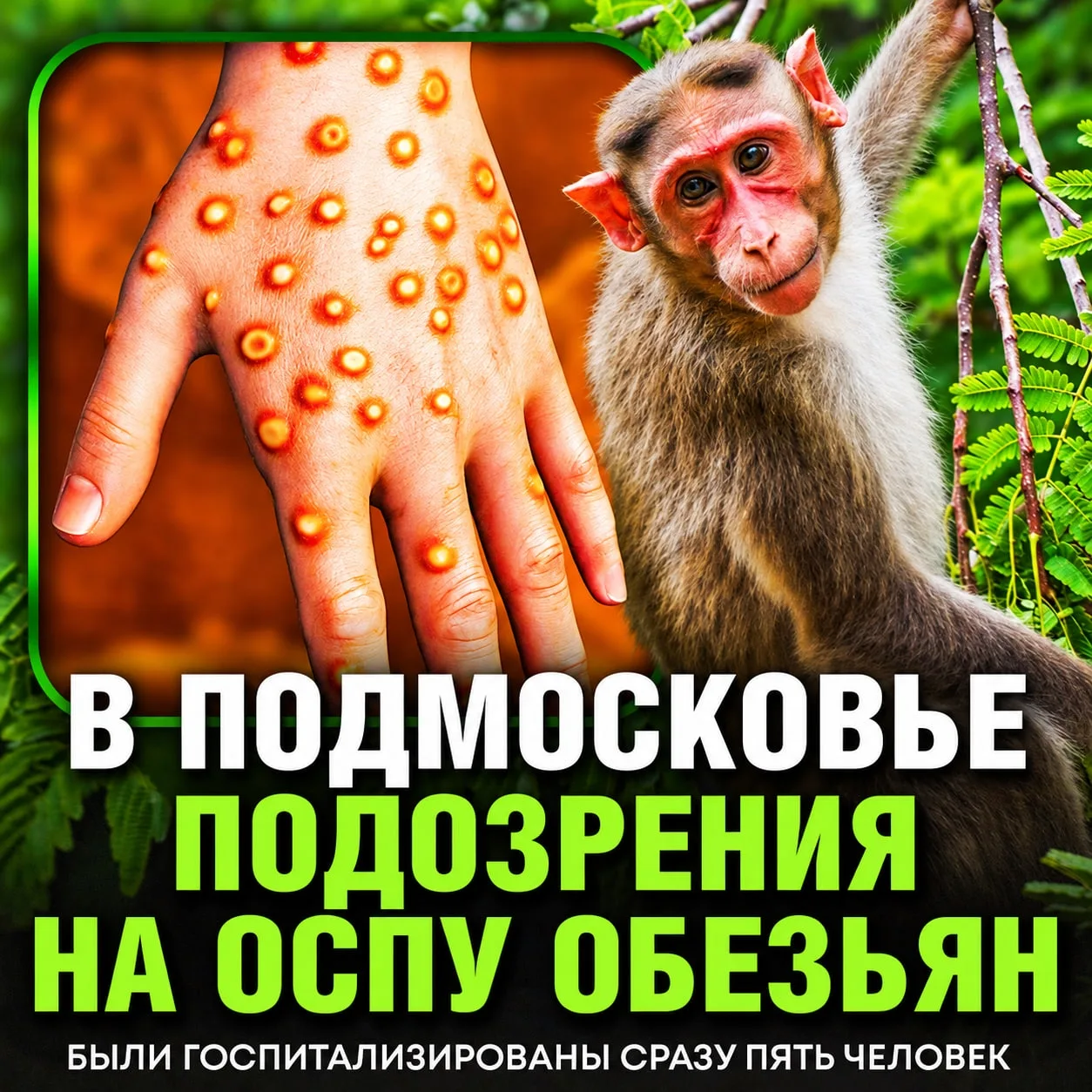 ‼ВСПЫШКА ОСПЫ ОБЕЗЬЯН В ПОДМОСКОВЬЕ — врачи бьют тревогу: сразу пятеро человек попали в...