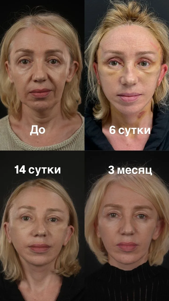 3 месяца после фейслифтинга( Deep Plane), медиальной платизмопластики, лобно-височного ...
