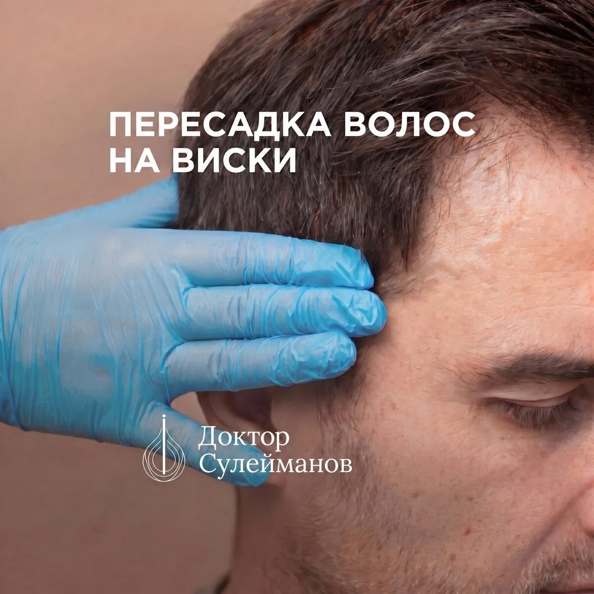 Пересадка волос в Саратове: 2000 графтов — 150 000 ₽