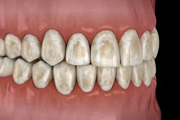🦷 Зубы «разрушаются», а стоматолог разводит руками? Возможно, дело в… хлебе.