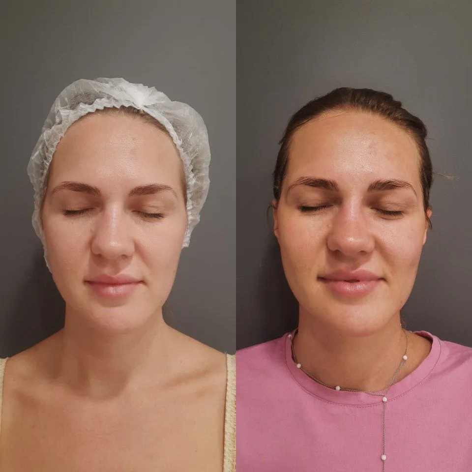 Мгновенный лифтинг БЕЗ инъекций и боли. Знакомьтесь, это FaceUp! ✨