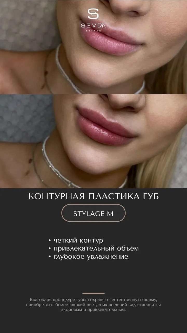 Продолжаем нашу любимую рубрику — контурная пластика губ! 💋