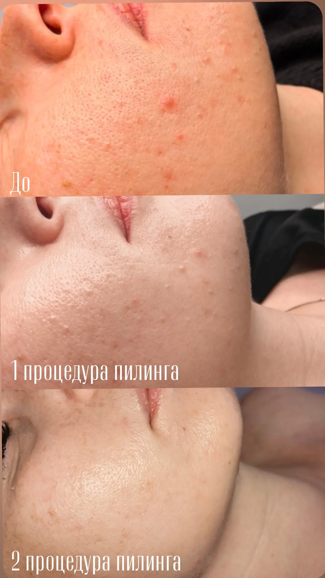 Ищу моделей для портфолио на новый премиальный пилинг-ремодулятор🔥