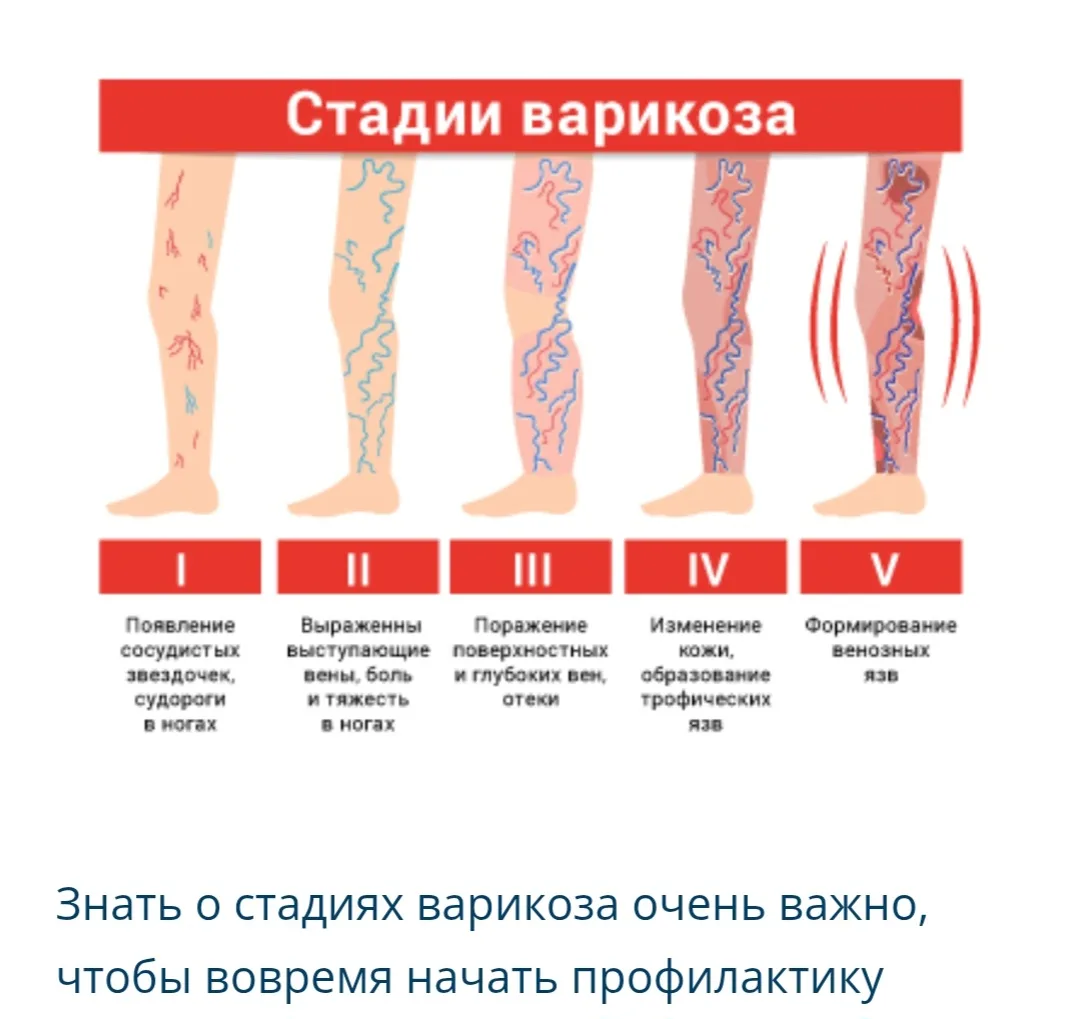 🩸 Стадии варикоза: что важно знать, чтобы не упустить время