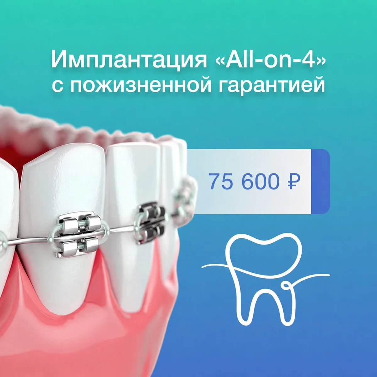 Импланты вместо зубов в Челнах! Лечение на любой бюджет