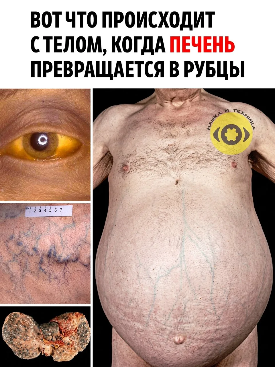 Печень может годами разрушаться практически незаметно. Человек продолжает жить обычной ...