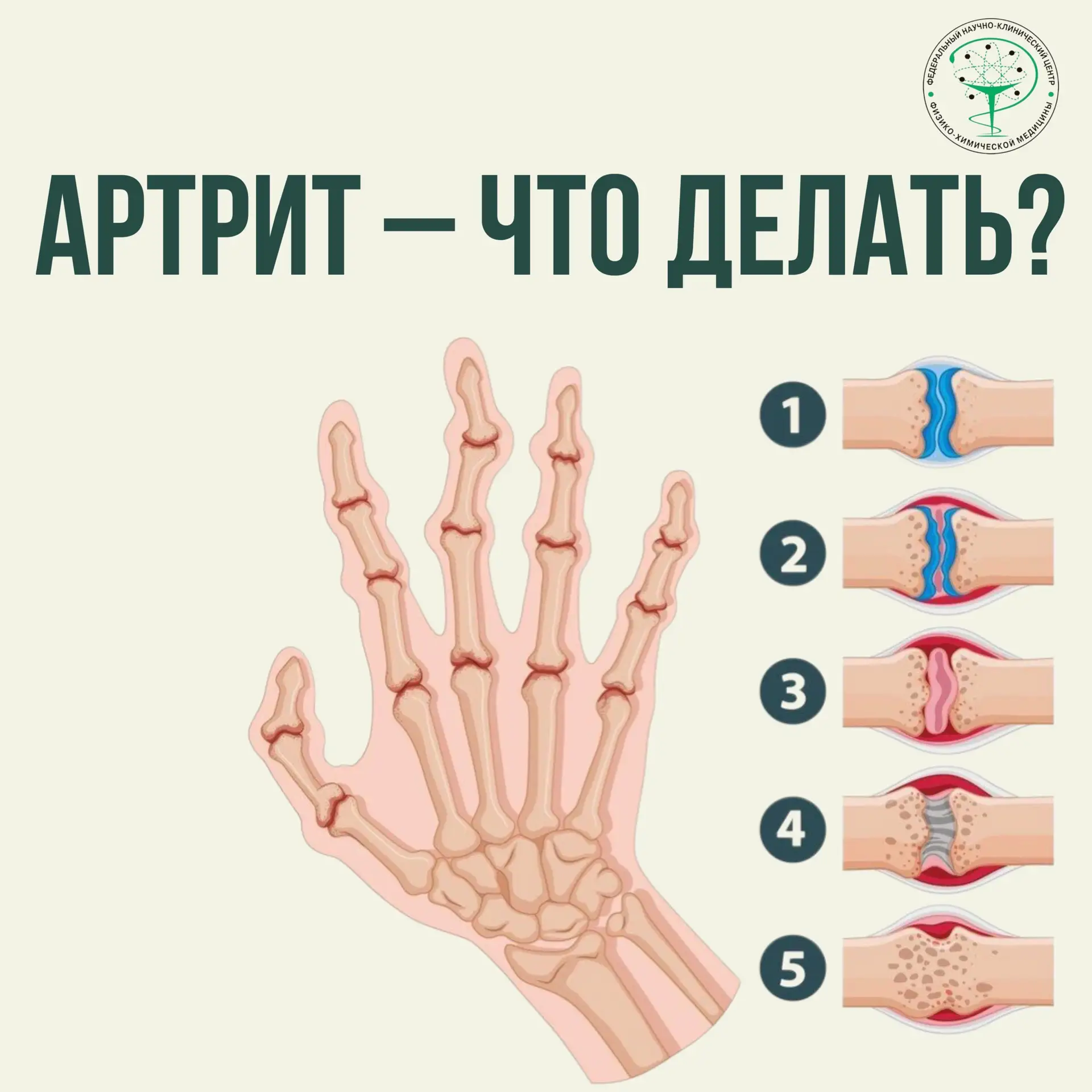 Артрит — что делать❓