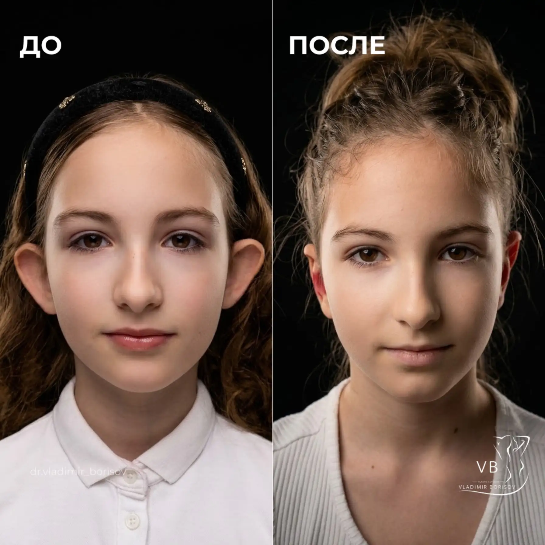 Двусторонняя отопластика.