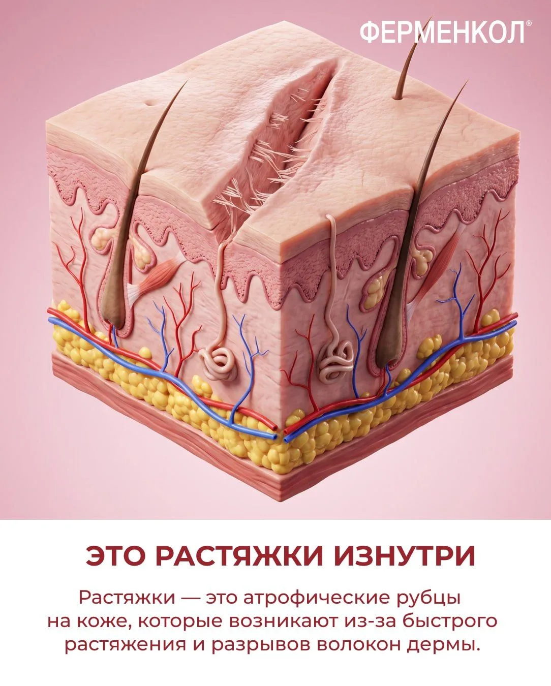 Вы знали, что растяжки — это не просто полоска на коже?