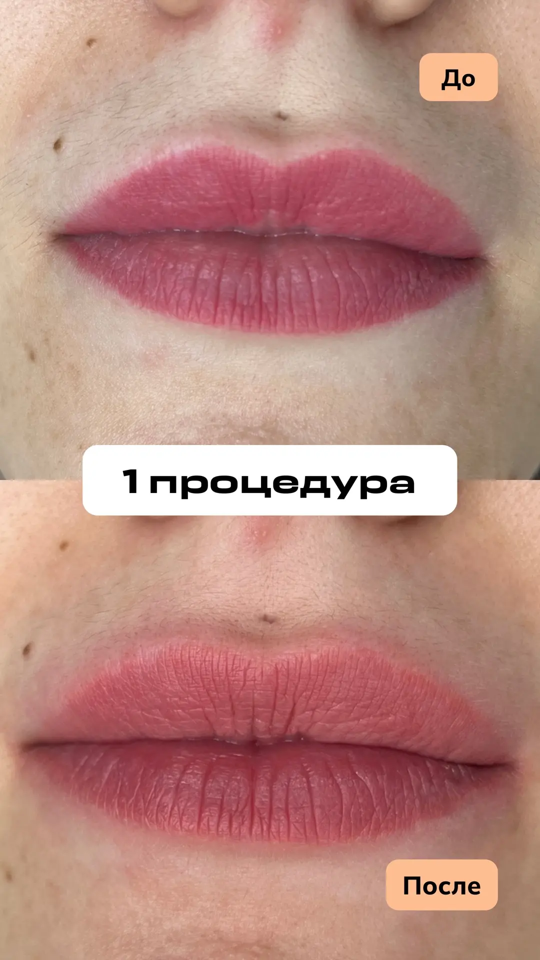 ПЕРМАНЕНТ ГУБ МОЖНО УДАЛИТЬ ЛАЗЕРОМ?