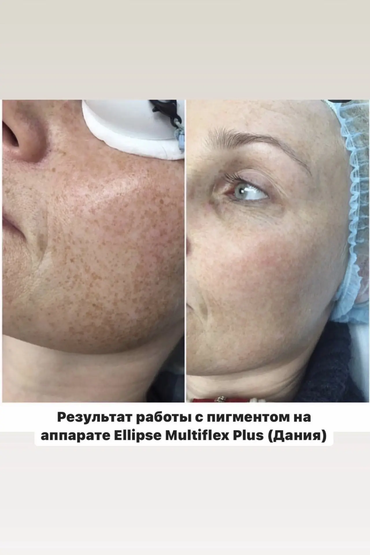 https://b-level.ru/uslugi-i-tseny/apparatnaya-kosmetologiya/ellipse-multi-flex-plus-ter...