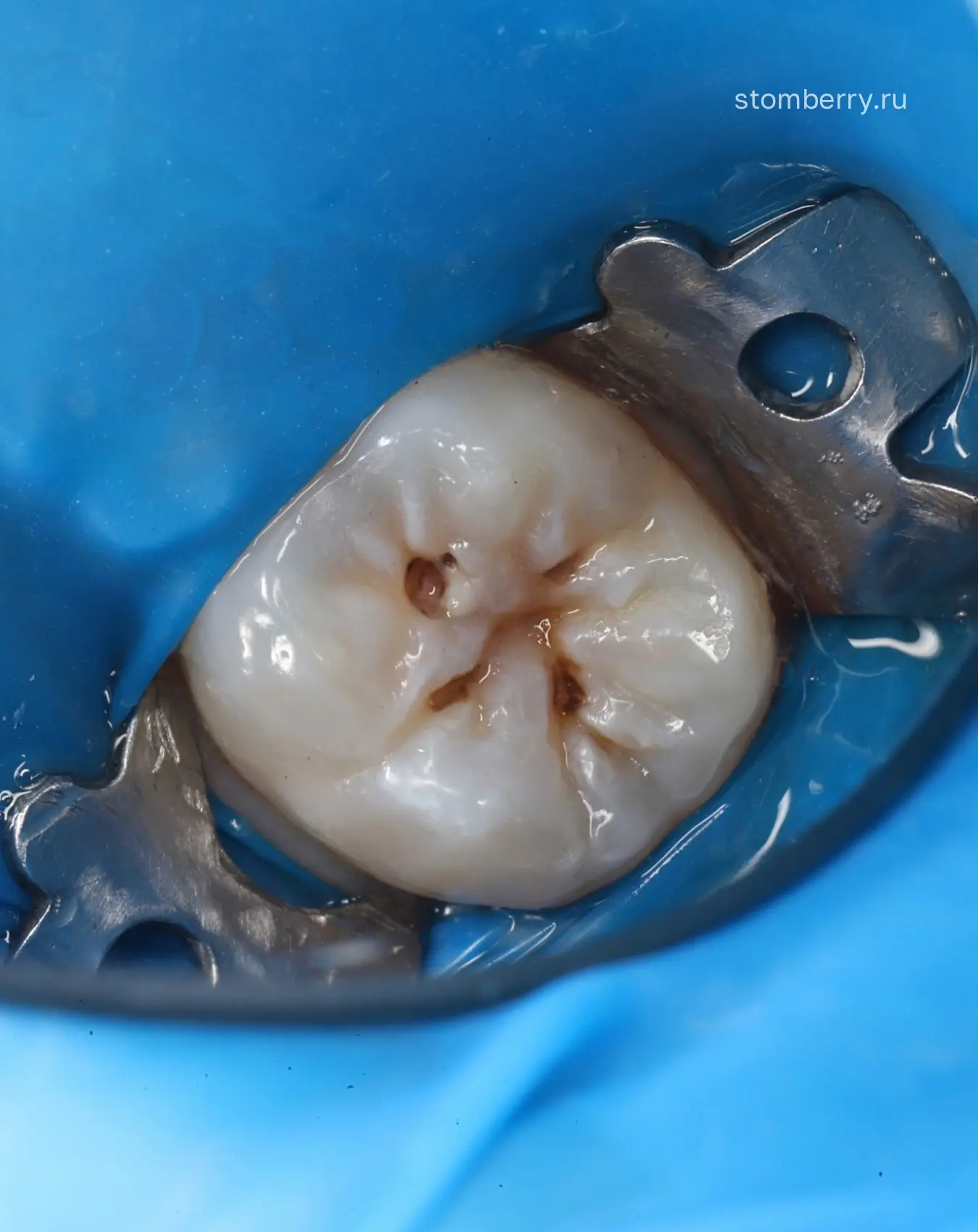 Лечение глубокого кариеса у пациента 11 лет 🦷