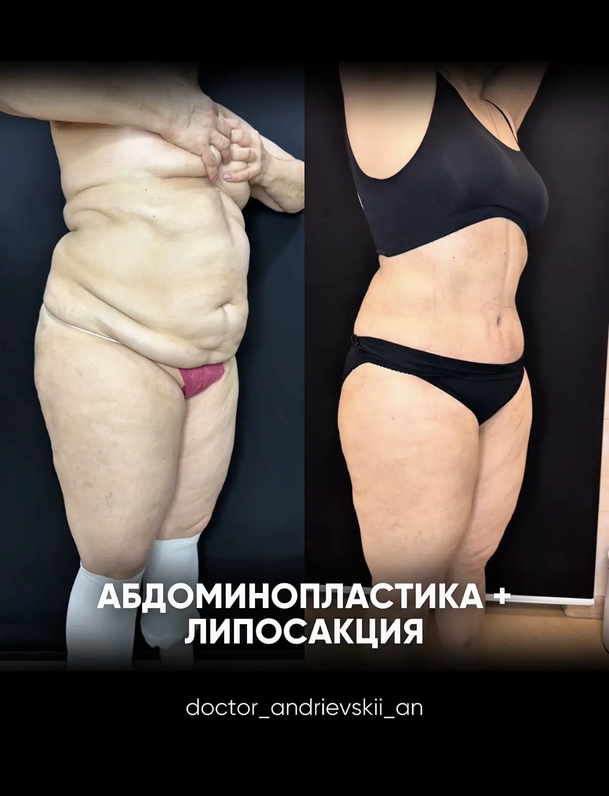 Липосакция или абдоминопластика?