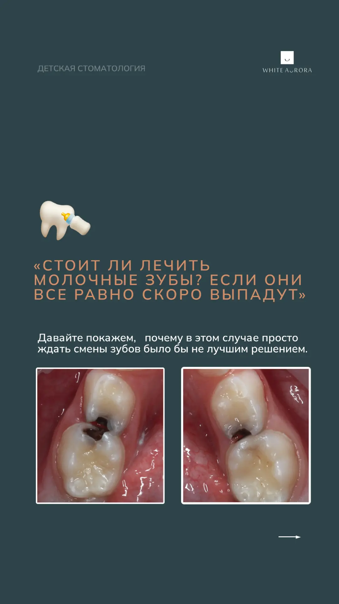 «Зачем лечить молочные зубы, если они все равно выпадут?» — вопрос, который часто задаю...